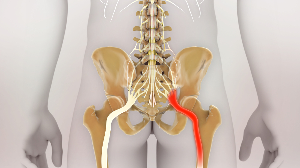 sciatica-pain