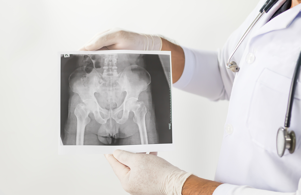 ankylosing-spondylitis