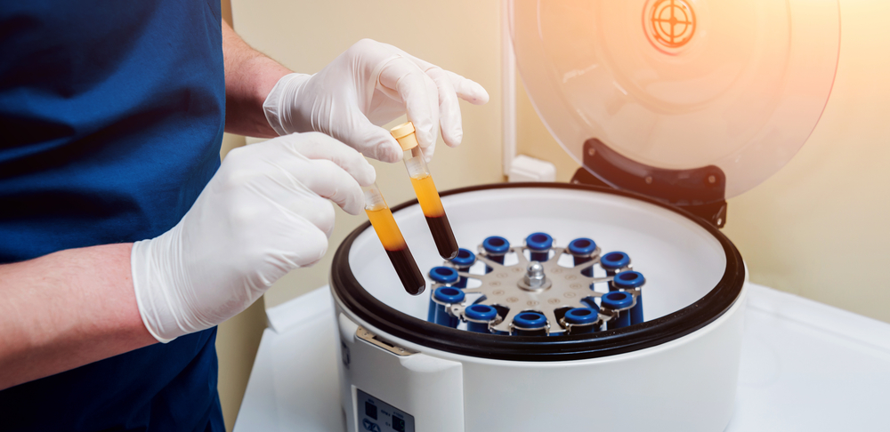 platelet rich plasma treatments