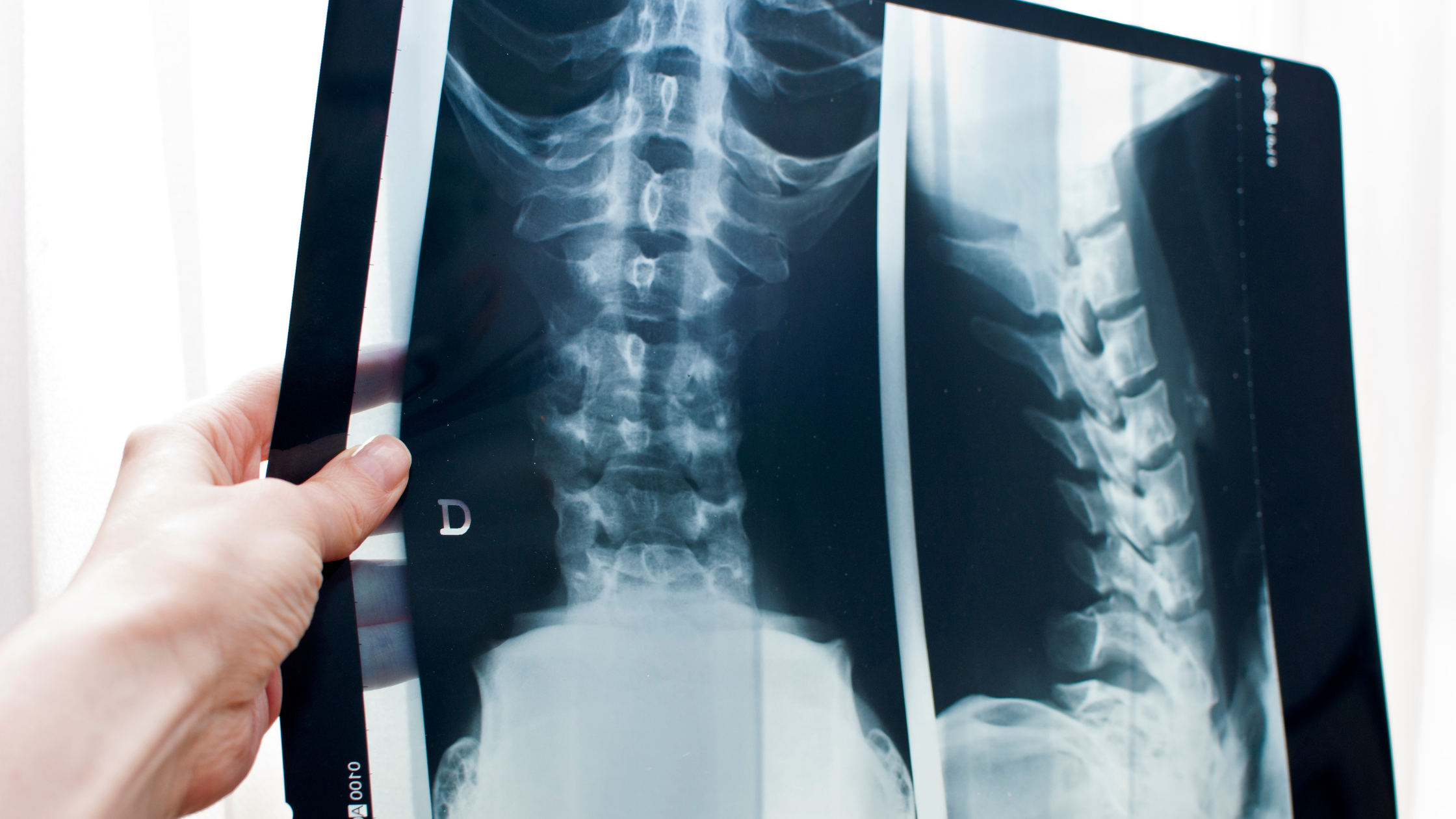 drg therapy for chronic pain
