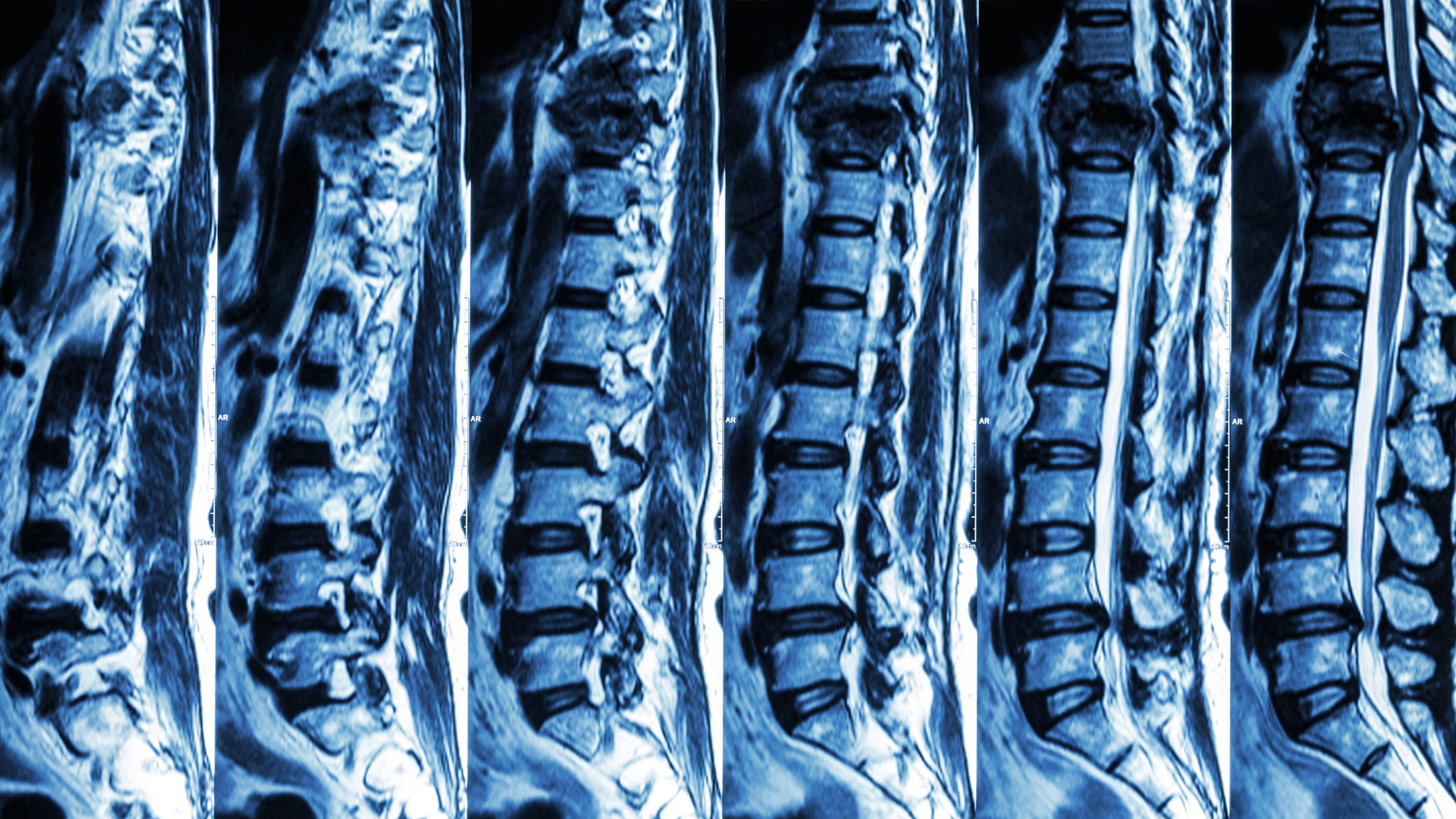 spinal compression fractures