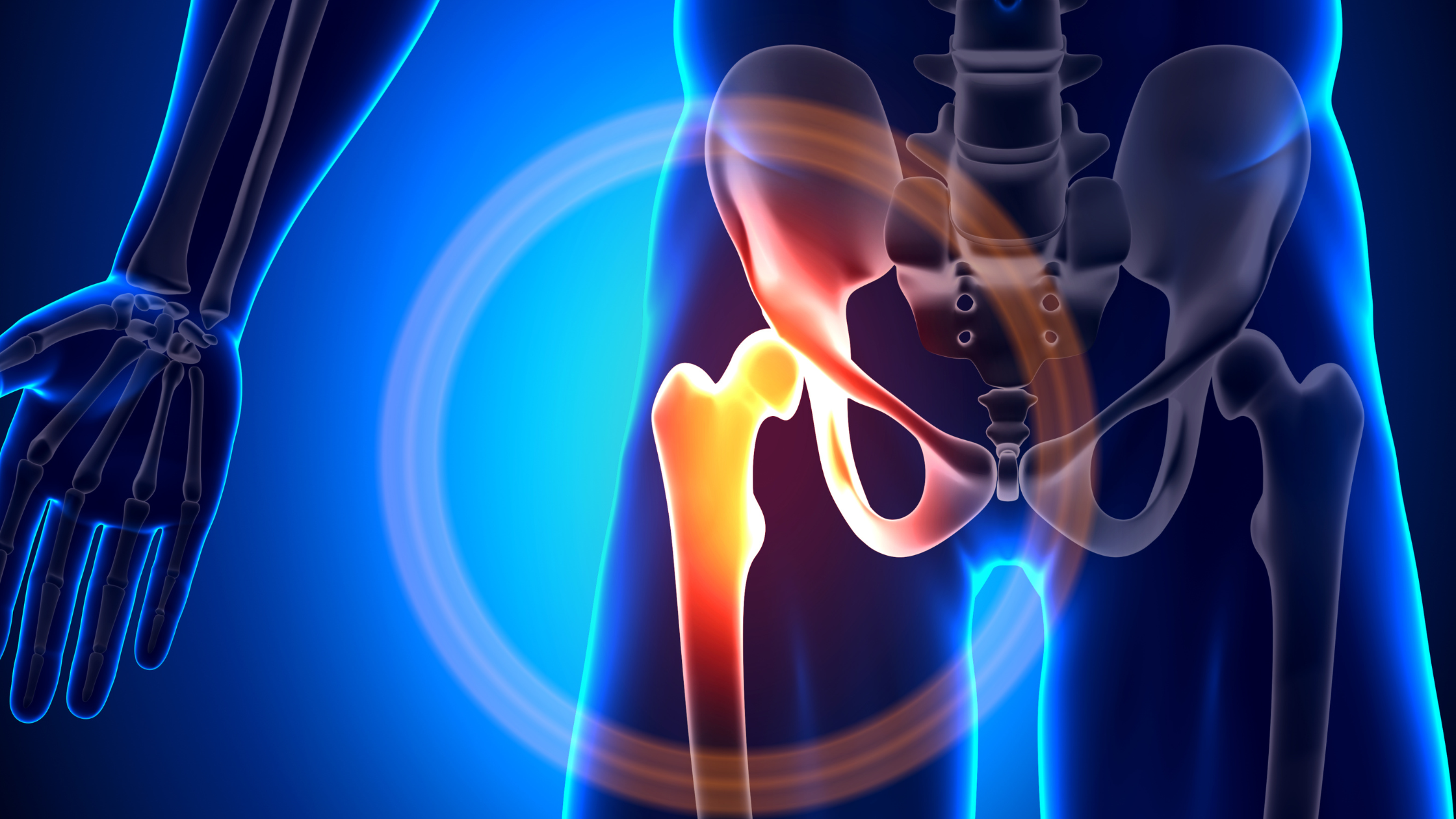 hip bursitis