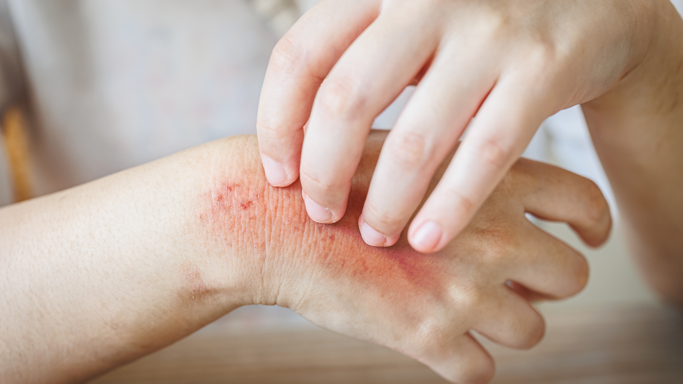 pain relief from shingles